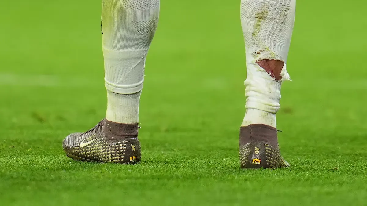 球袜被直接踢破！姆巴佩遭拜仁后卫塔犯规后，血痕清晰可见